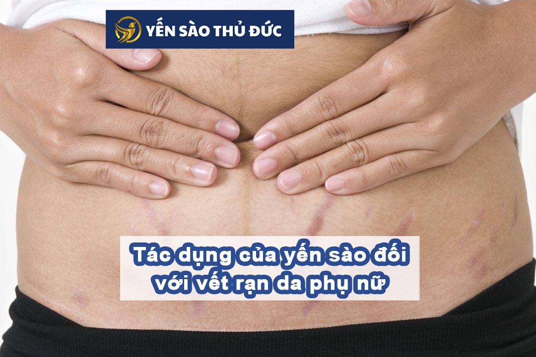 Tác dụng của yến sào đối với vết rạn da phụ nữ