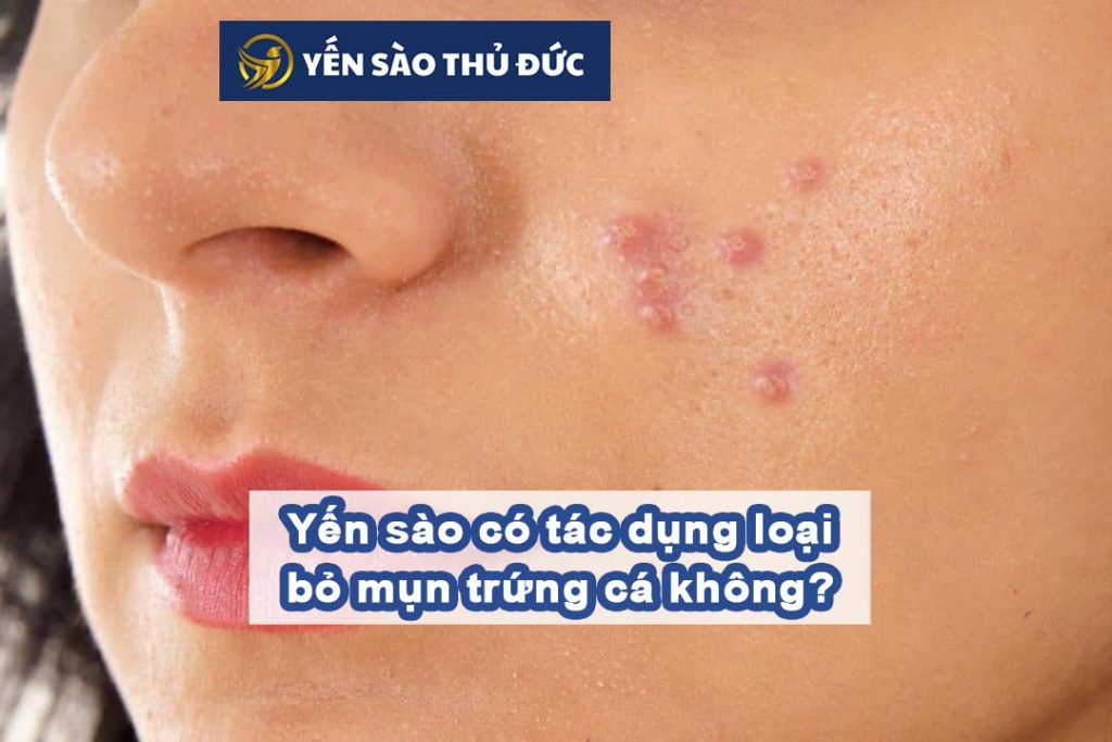 Yến sào có tác dụng loại bỏ mụn trứng cá không?